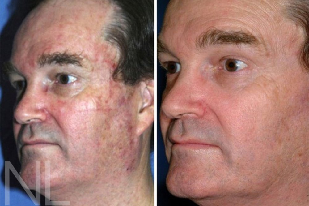 Fraktionierter CO2 Laser vorher/nachher | Dr. med ...