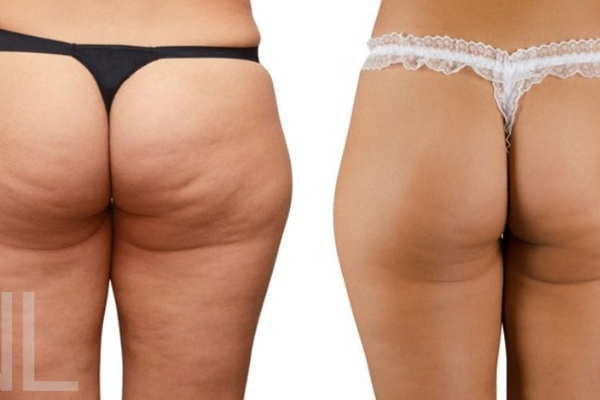 Cellulite