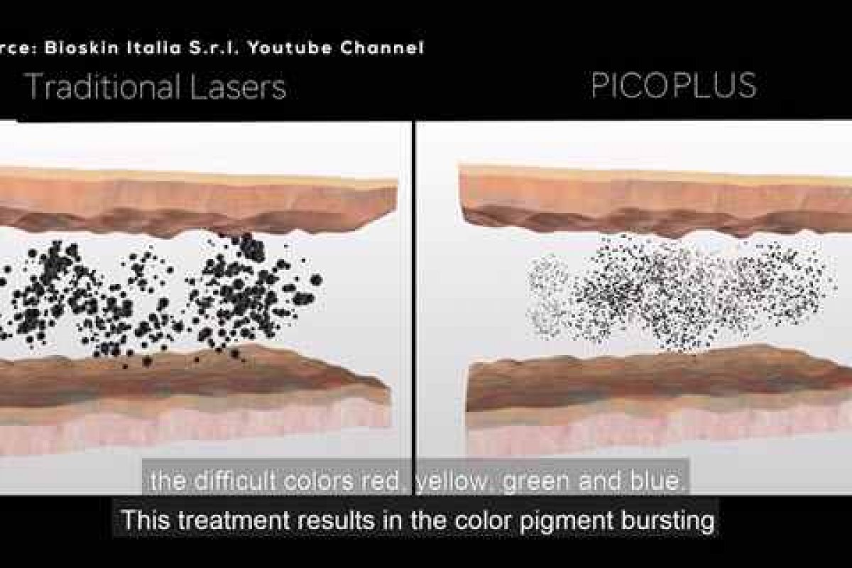 PicoPlus Laser