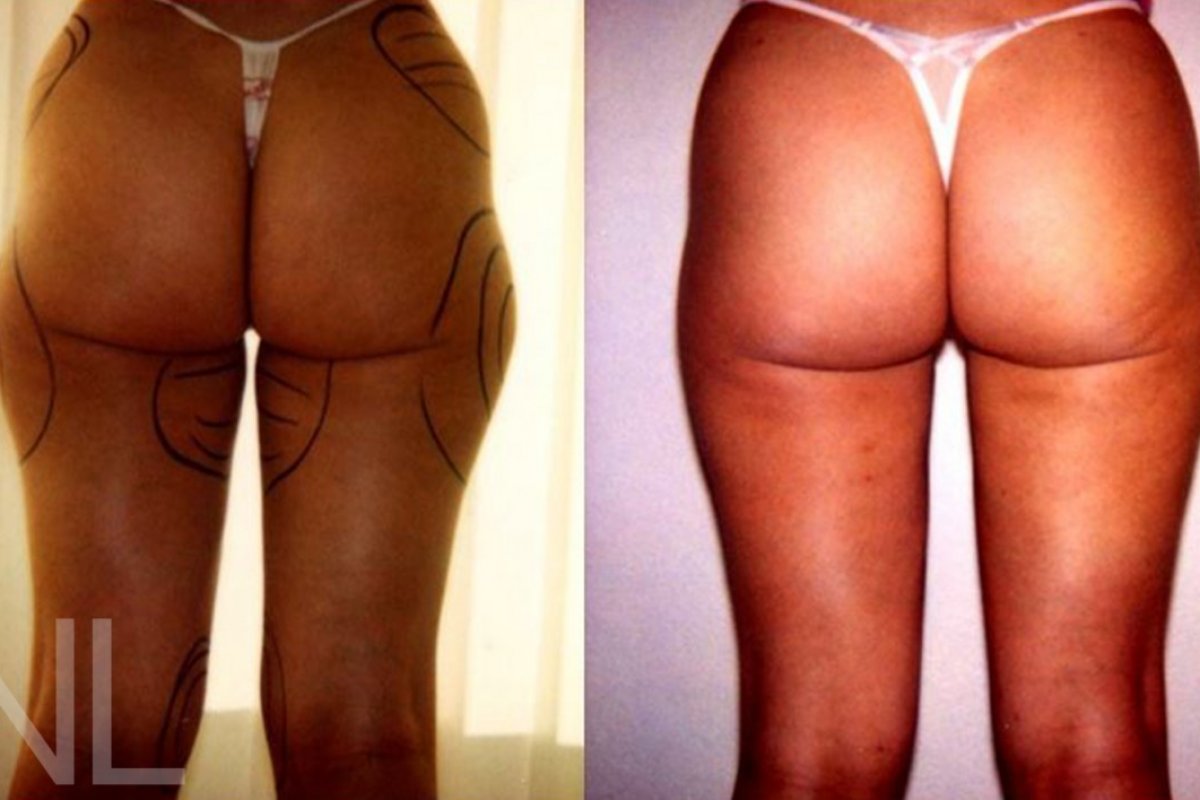 Liposuction