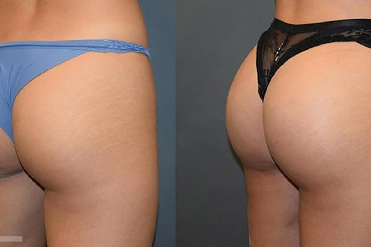 Buttock Augmentation