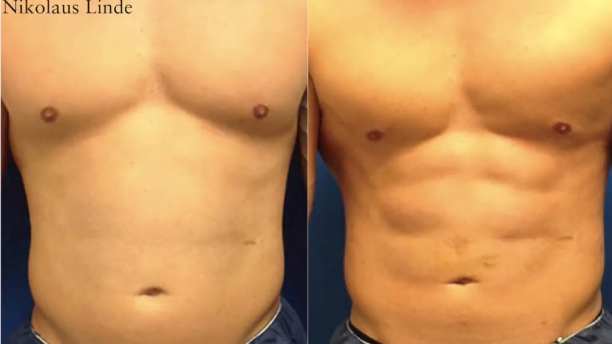 Sixpack