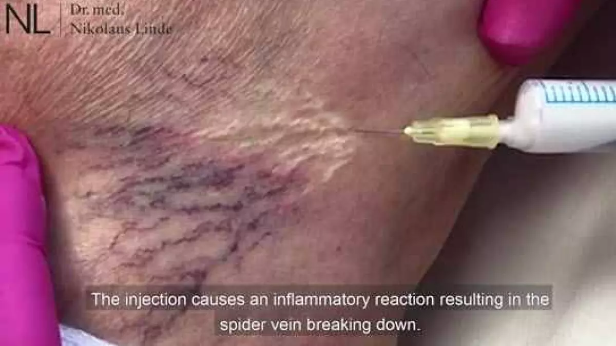 Spider Veins