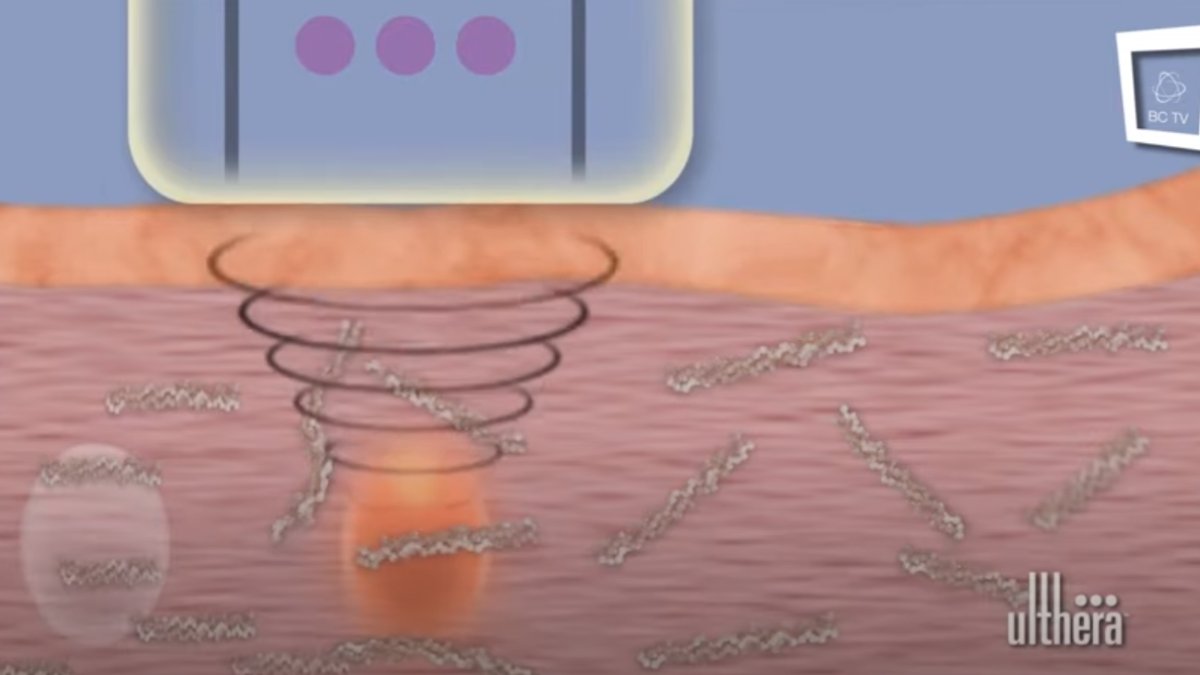 Ultherapy: Hautstraffung ohne Spritze durch Ultraschall