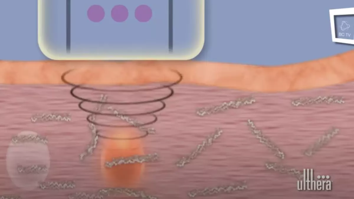 Ultherapy: Hautstraffung ohne Spritze durch Ultraschall